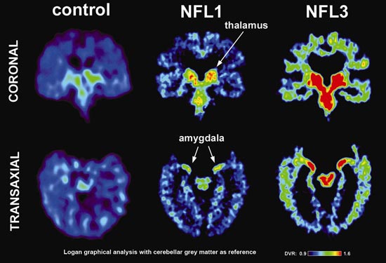 cte scan of brains