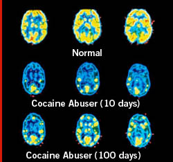 brain
